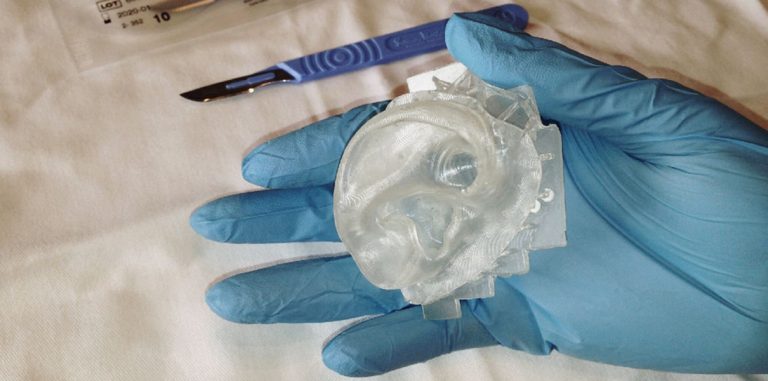 В Великобритании врачи печатают импланты уха на 3D-принтере