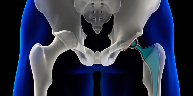 3D принтер для тазобедренных суставов прошел клинические испытания