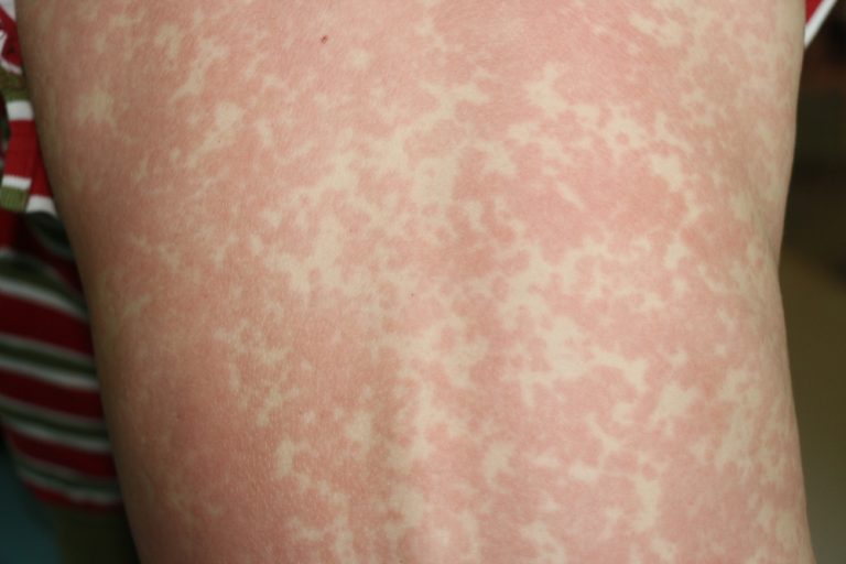 Германия приняла закон об обязательной вакцинации от кори