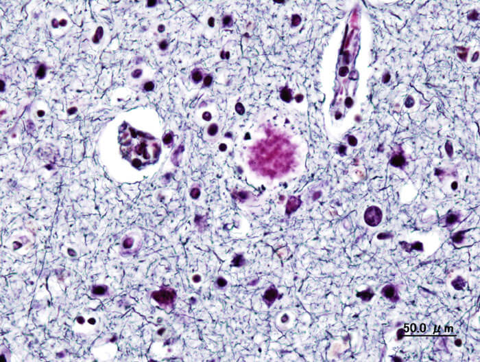 Удивительное сходство между болезнью Альцгеймера и длительным COVID-19 обнаружили биологи