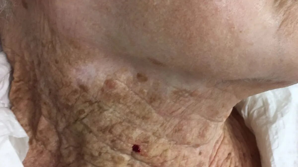 Женщина 40 лет не пользовалась кремом от Солнца. Посмотрите, что стало с ее  кожей