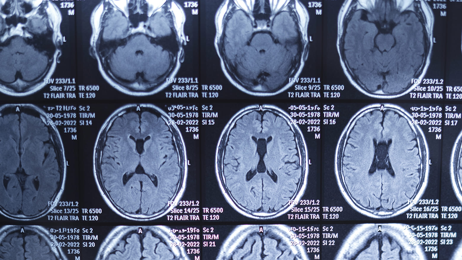 Лекарство от рассеянного склероза устраняет симптомы болезни Альцгеймера