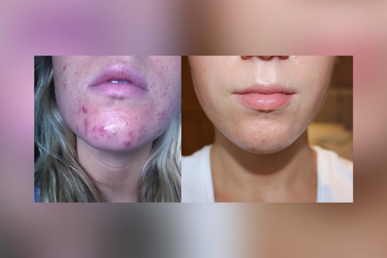 Наночастицы и новый препарат объединили для принципиально нового лечения прыщей