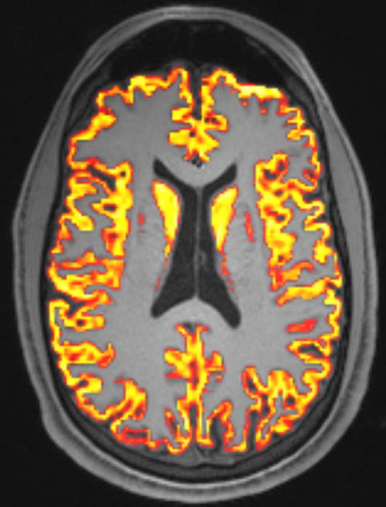 Постковидный синдром связали с микроскопическими изменениями в мозге