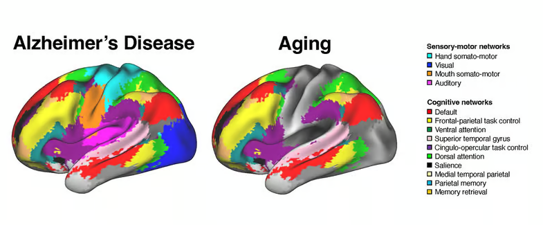 Болезнь Альцгеймера влияет на мозг не так, как считали ученые