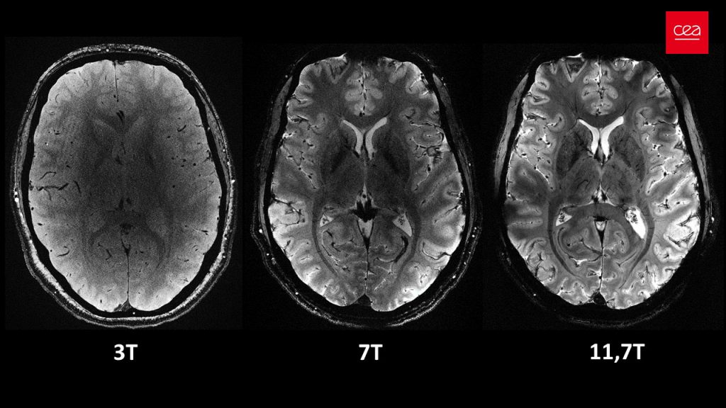 La macchina per risonanza magnetica più potente ha acquisito rapidamente immagini dettagliate del cervello