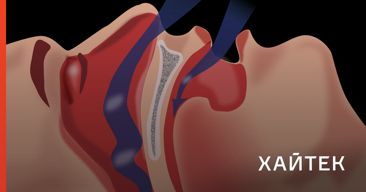 Последствия храпа. Апноэ от храпа.