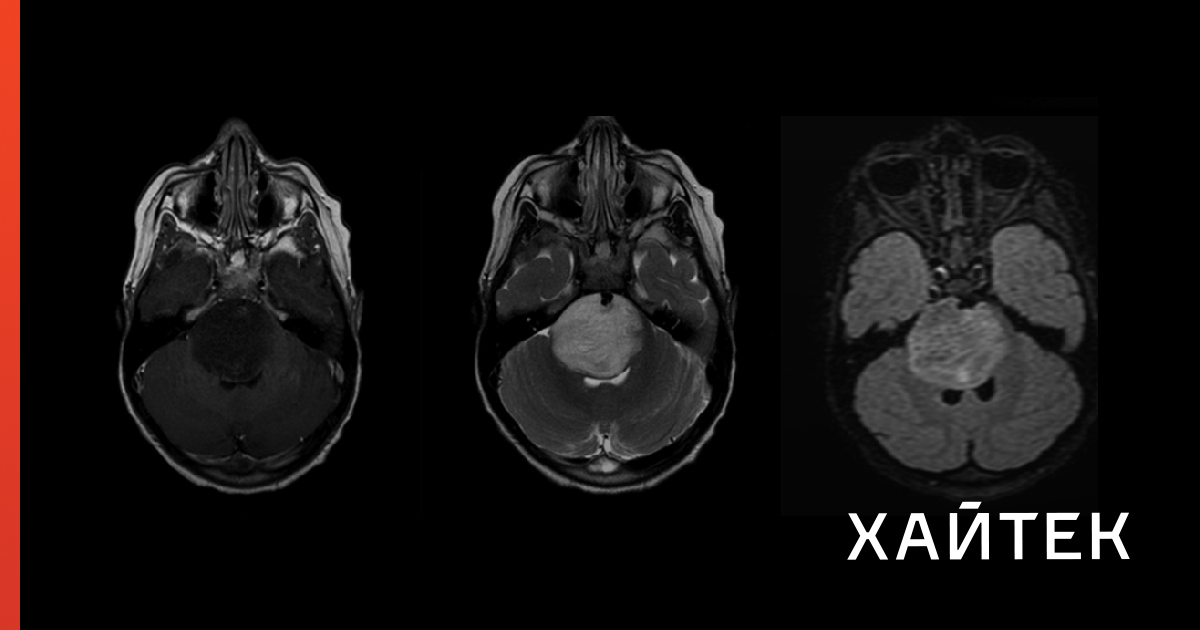 Scientists found that a diet low in certain amino acids increased the susceptibility of glioblastoma cells to ferroptosis and chemotherapy.