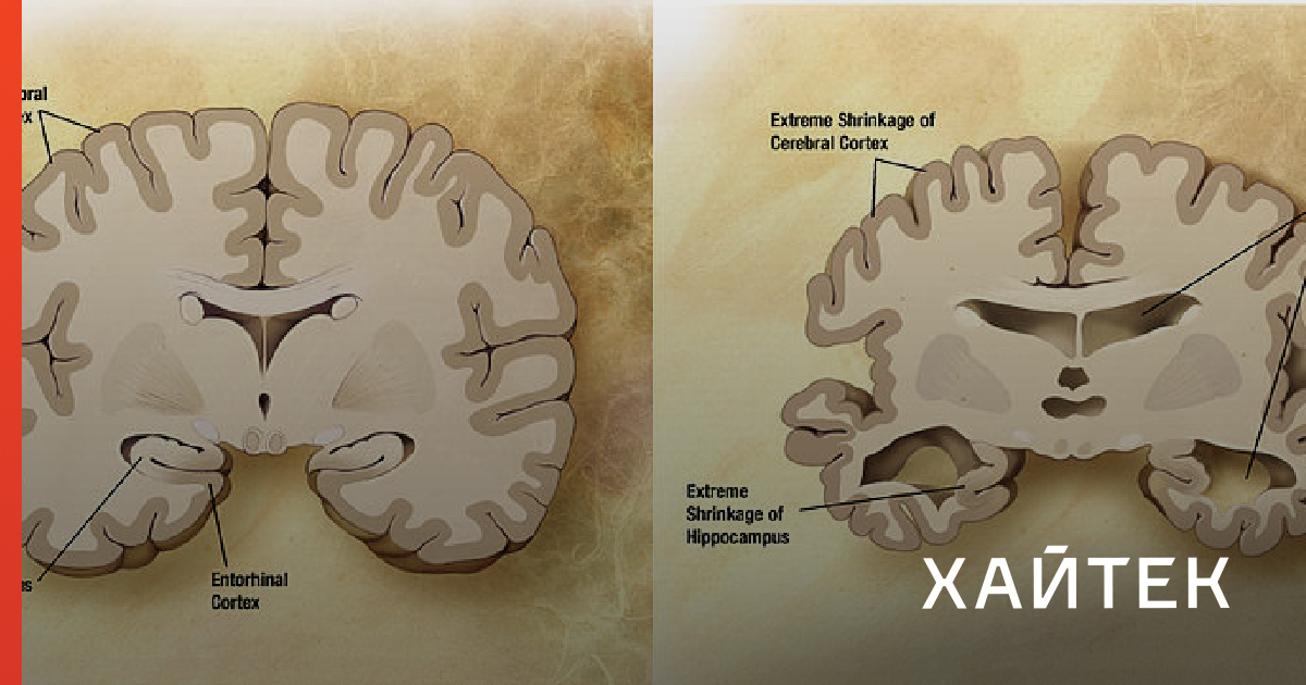 Альцгеймер где верблюд